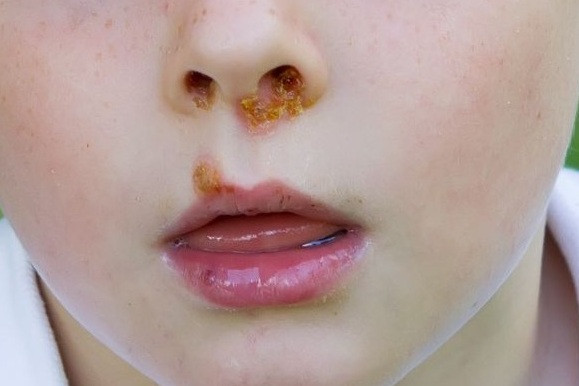 Infeksi Bakteri Kulit (Impetigo)